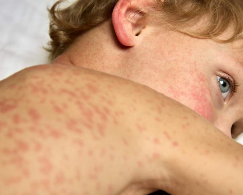 بیش از ۳۱۰۰ مورد ابتلا به سرخک در آمریکا