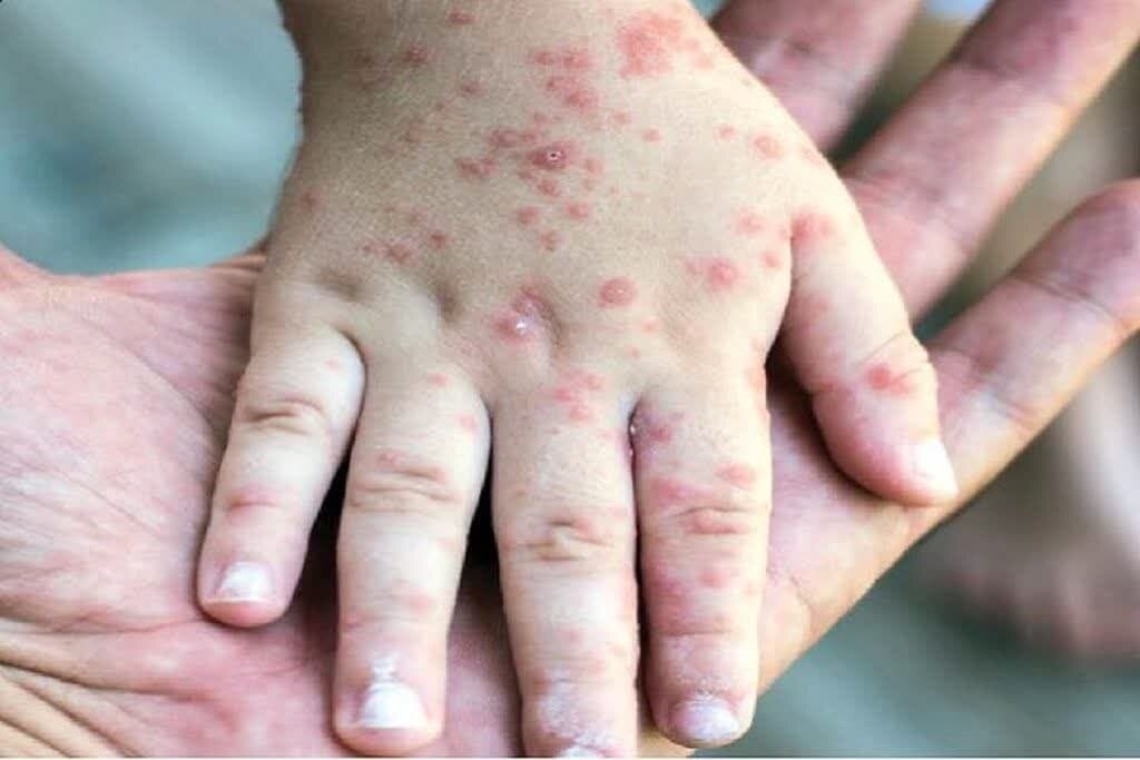 سرخک؛ یکی از مسری‌ترین بیماری‌ها و راه پیشگیری از آن