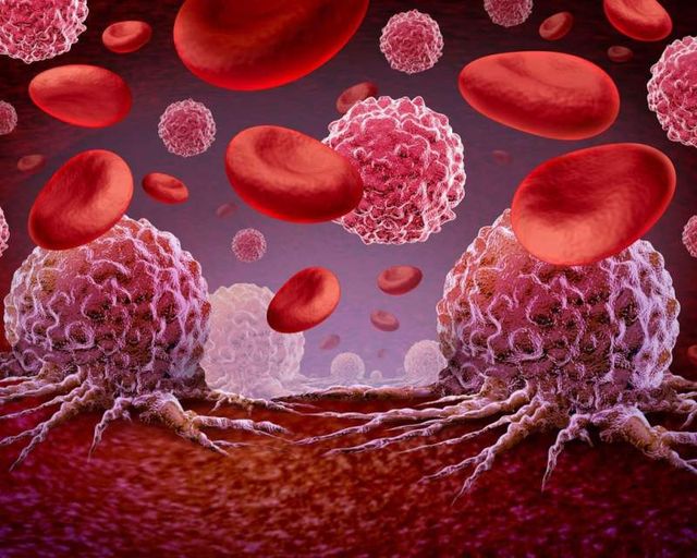 موفقیت سلول‌درمانی آزمایشی BMS در نوعی دشوار سرطان خون